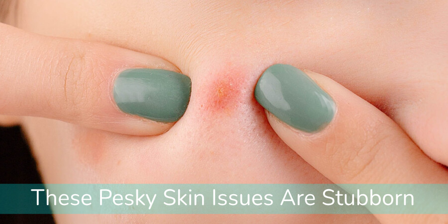 These Pesky Skin Issues Are Stubborn